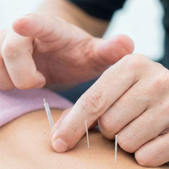 dry needling 2
